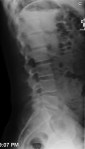 Degenerative Disc - Yea!